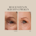 Voor-en-na vergelijking van de huid rond de ogen na 8 weken gebruik van Natural Magic™ Amazing Eye™ Cream.