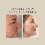 Voor-en-na vergelijking van de huid na 8 weken gebruik van Natural Magic™ Firming Serum.