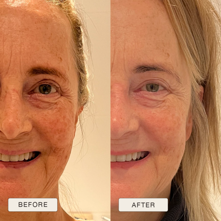 Testimonial van Helga met voor en na foto’s na gebruik van de Natural Magic™ skincare lijn.