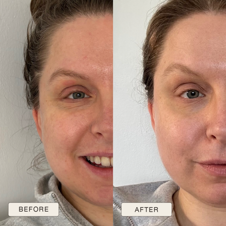Testimonial van Laura met voor en na foto’s na gebruik van de Natural Magic™ skincare lijn.