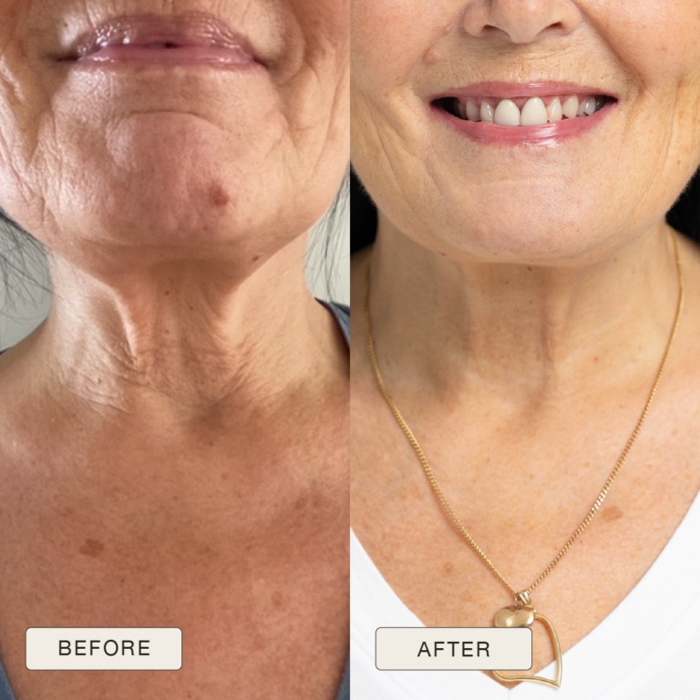 Testimonial van Paivi met voor en na foto’s na gebruik van de Natural Magic™ skincare lijn.
