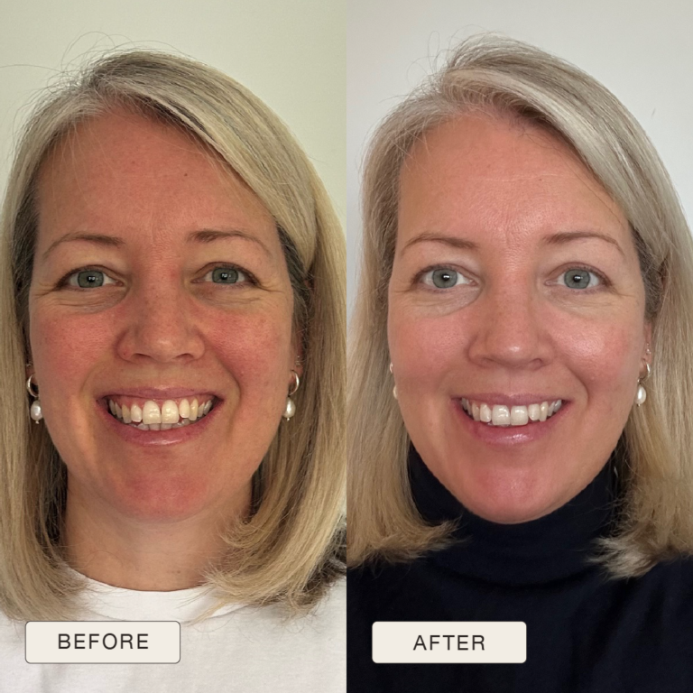 Testimonial van Rebecca met voor en na foto’s na gebruik van de Natural Magic™ skincare lijn.