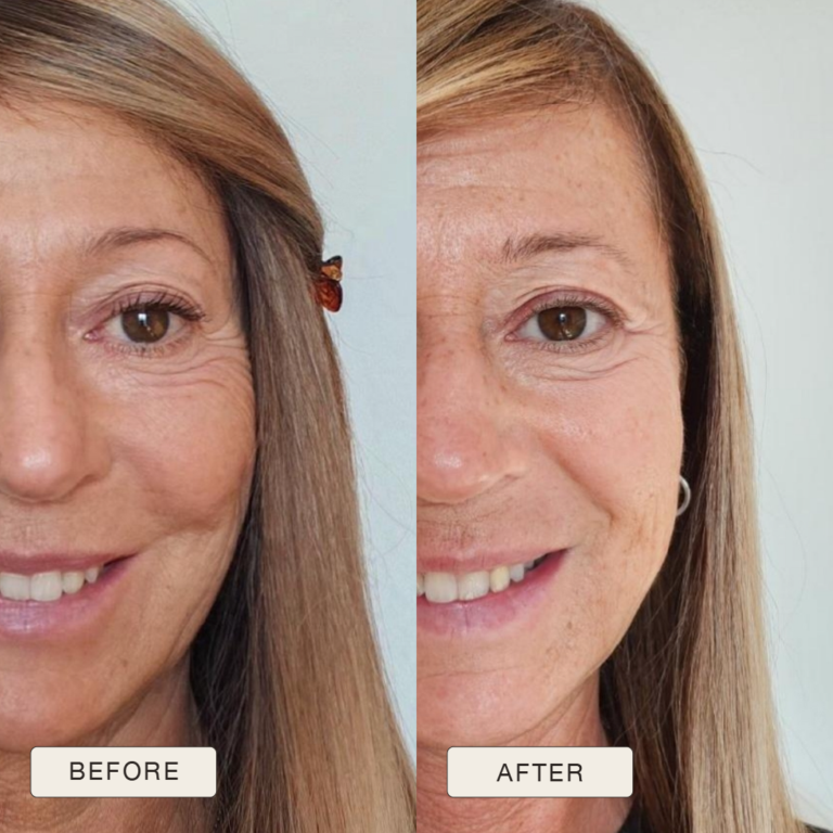 Testimonial van Rosanna met voor en na foto’s na gebruik van de Natural Magic™ skincare lijn.
