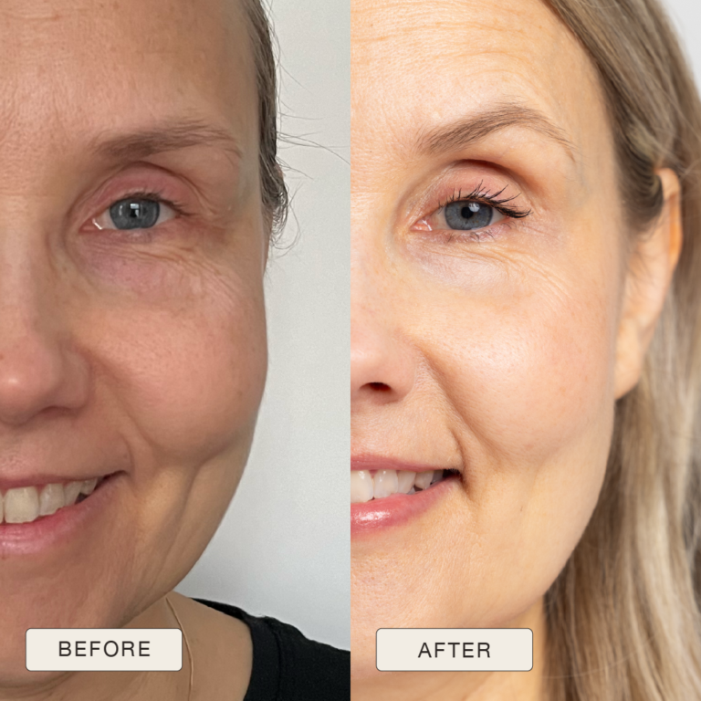 Testimonial van Teija met voor en na foto’s na gebruik van de Natural Magic™ skincare lijn.